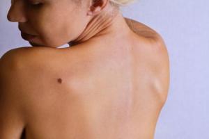 208796-675x450-woman-looking-at-birthmark-on-back